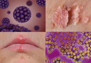 Read more about the article Condiloma acuminado (HPV) – Sinais e sintomas