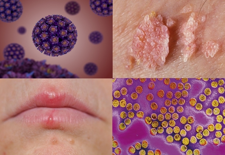 You are currently viewing Condiloma acuminado (HPV) – Sinais e sintomas